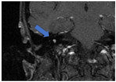 MRI Observation After Intralabyrinthine and Vestibular Schwannoma Resection and Cochlear Implantation